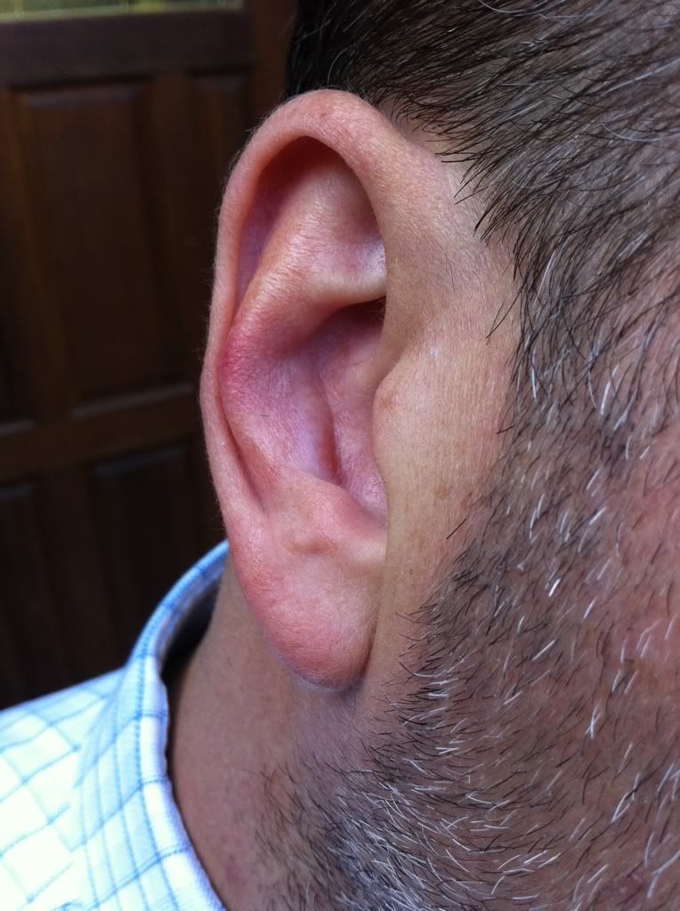 The Definitive Cauliflower Ear Thread (please sticky) Page 12