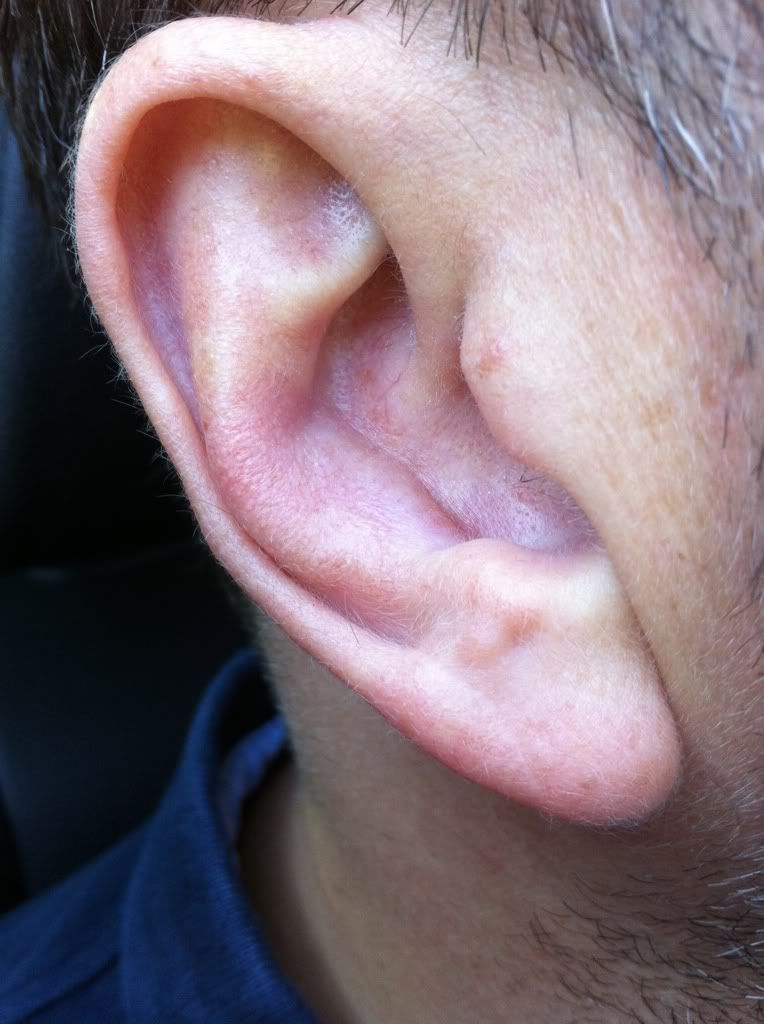 The Definitive Cauliflower Ear Thread (please sticky) Page 12