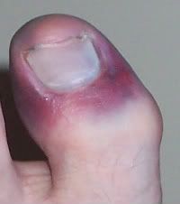 Toe_1.jpg