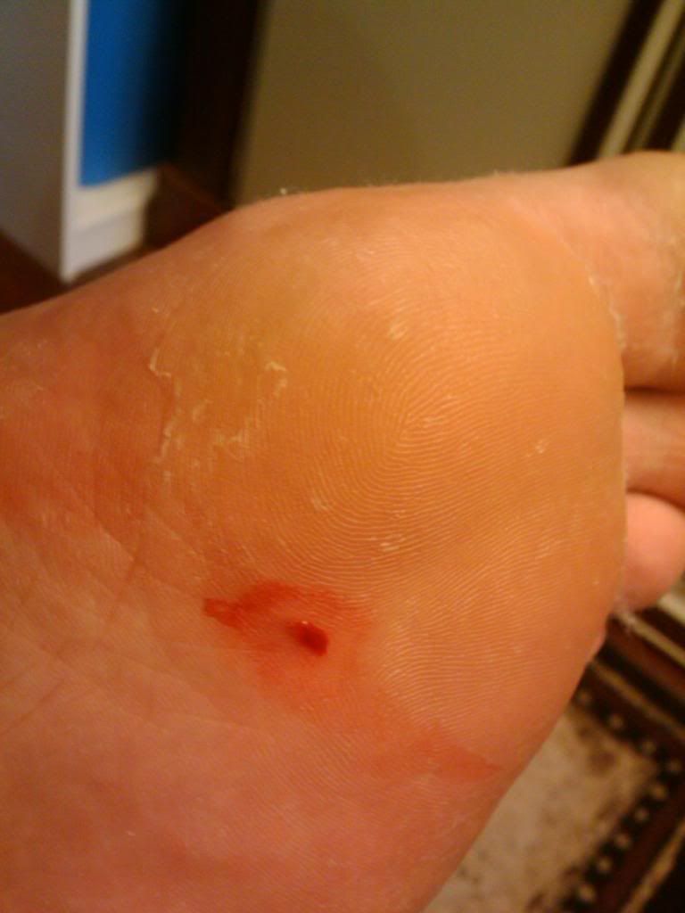 Just stepped on a rusty nail. Do I need tetanus shot? (pics